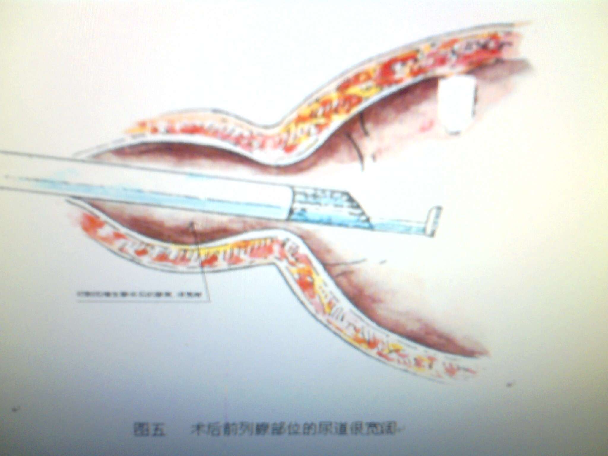 前列腺微創手術示意圖