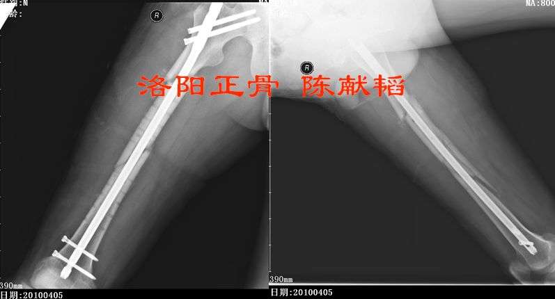 大腿骨折钢板固定失败再手术治疗
