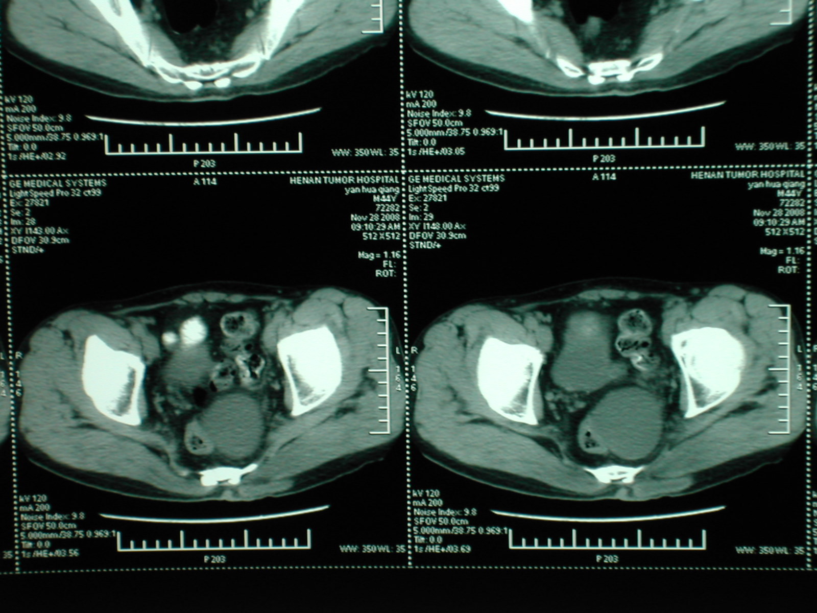 骶前囊肿治疗的认识与体会