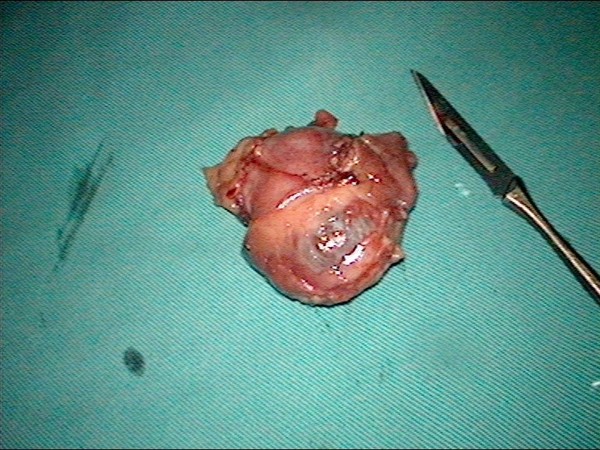 高难度手术荟萃17——囊性肾癌——微创腹腔镜肾部分切 - 好大夫在线