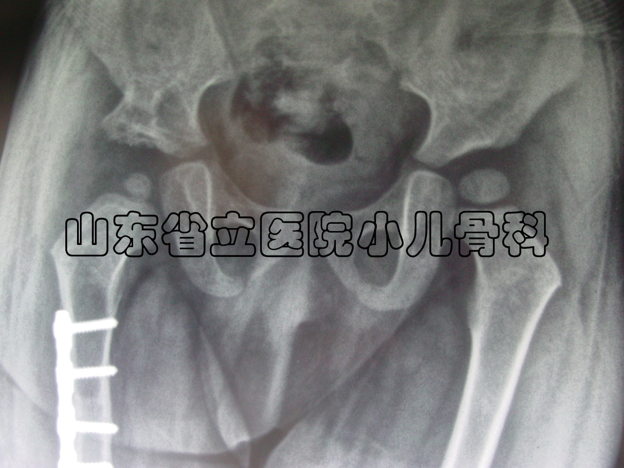 山東省立醫院小兒骨科目前每年收治髖關節脫位約500例(不包括門診治療