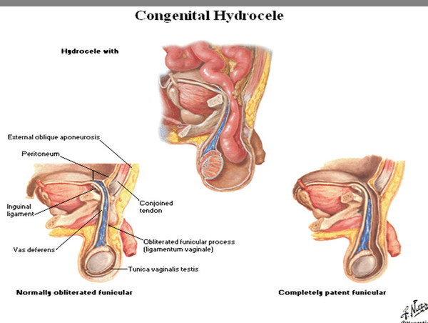 巨大斜疝(疝内容物进入阴囊)腹股沟疝可能出现,发生在任何年龄,但高峰