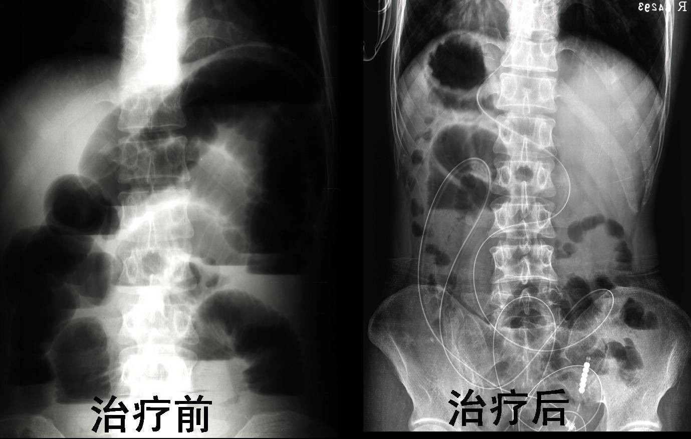 專用腸梗阻導管置入治療腸梗阻