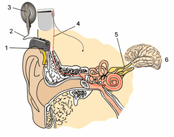 人工耳蝸如何讓耳聾患者聽到聲音