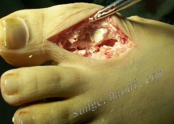 远离痛风 ,可怕的痛风石--附手术图片 - 好大夫在线