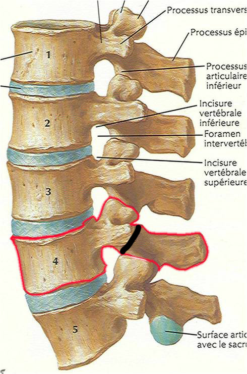 峡部裂性腰椎滑脱