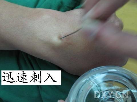 腱鞘囊肿_腱鞘囊肿_腱鞘囊肿治疗方法 - 好大夫在线