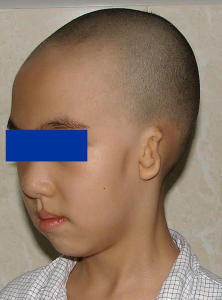 各式各样的耳廓畸形-半侧颜面短小