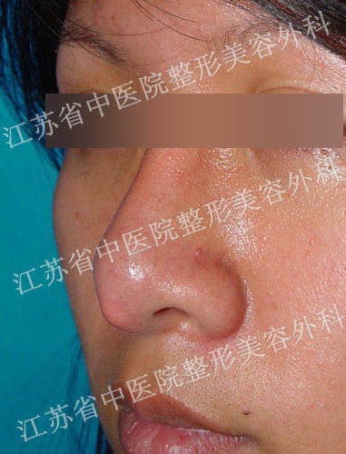 江苏省中医院整形外科主任黄金龙教授从事整形20余年,对人体鼻梁结构