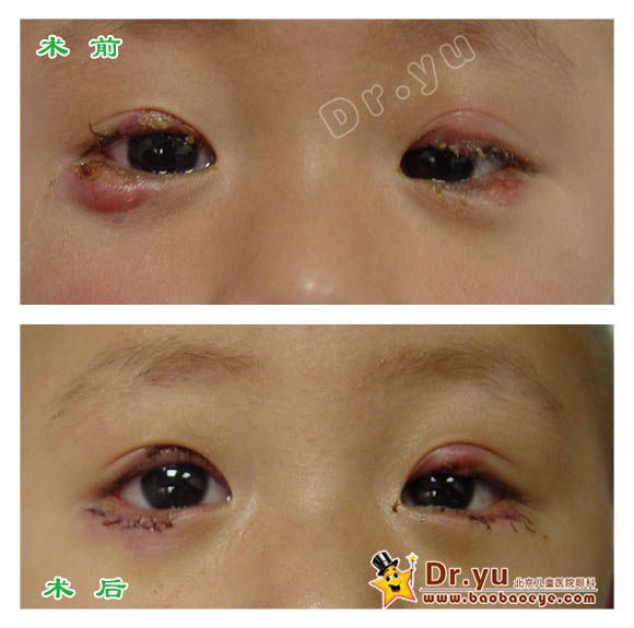 以前我们做医生的追就是早点手术,手术漂亮一点,尽量让孩子眼睛的瘢痕