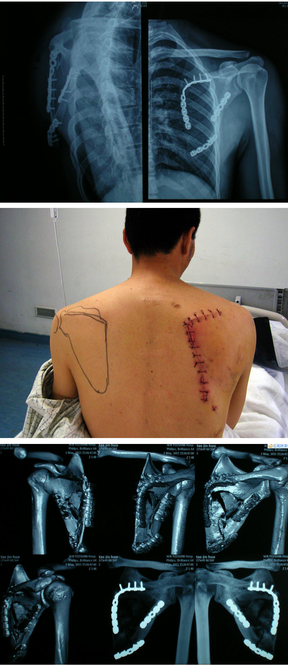 肩胛骨畸形手术图片