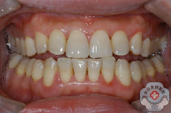 牙齿釉质发育不全树脂美容修复 - 好大夫在线