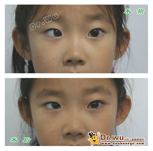 共同性内斜视术前术后照片
