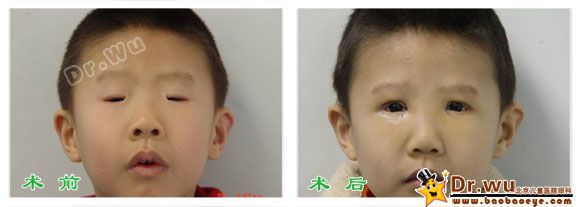 患儿男3岁先天性小睑裂综合征,双眼睑裂小,内眦间距宽,双眼上睑下垂.