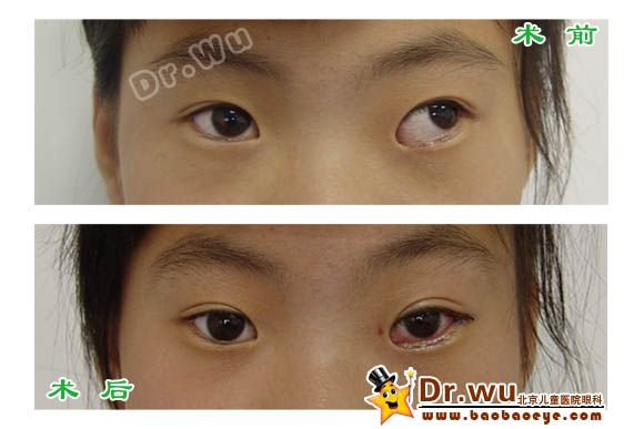 外斜视术前术后照片