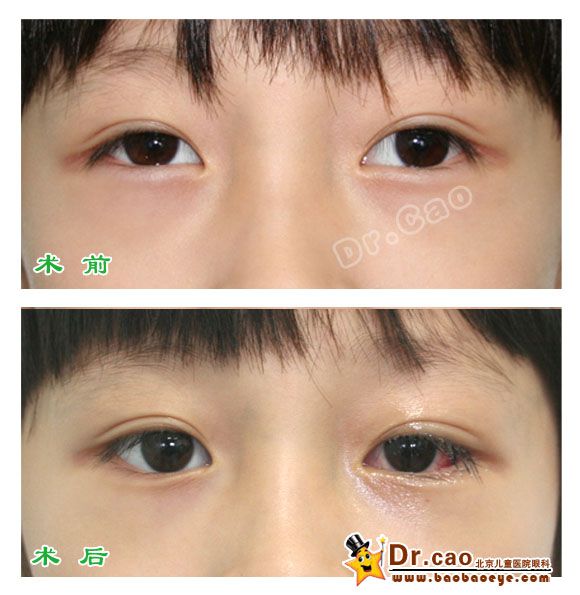 间歇性外斜视术前术后1