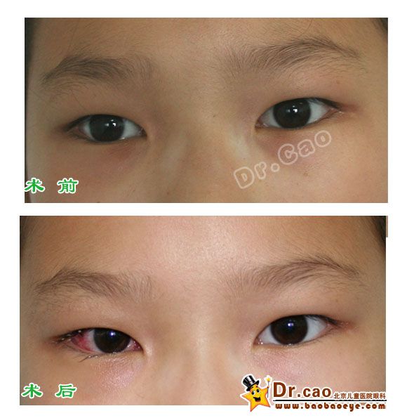 间歇性外斜视术前术后1