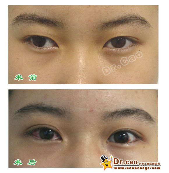 间歇性外斜视术前术后1