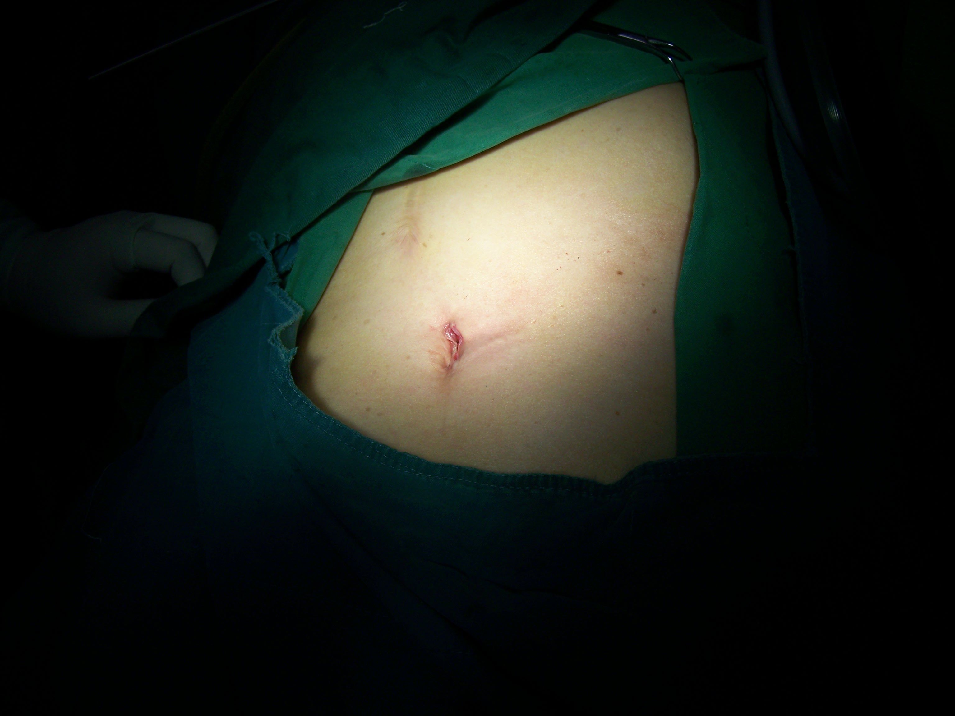 单孔腹腔镜切口图片