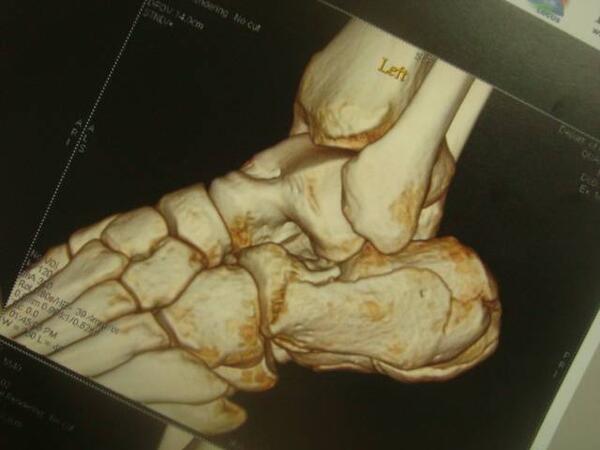 足部骨折2跟骨骨折手術圖片