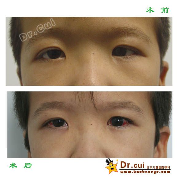 内斜视术前术后照片2