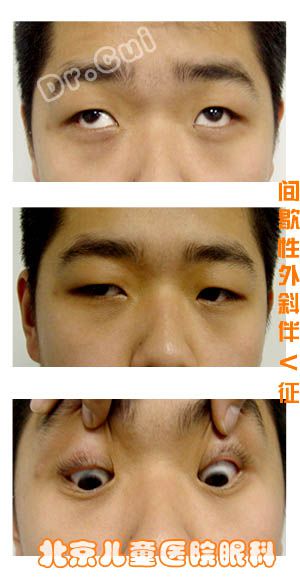外斜视术前术后照片