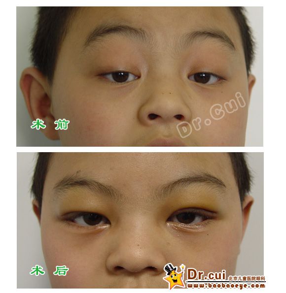 上睑下垂术前术后照片3