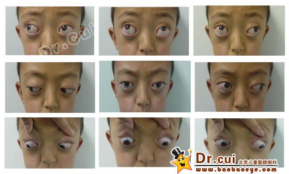 麻痹性斜视术前术后照片 - 好大夫在线