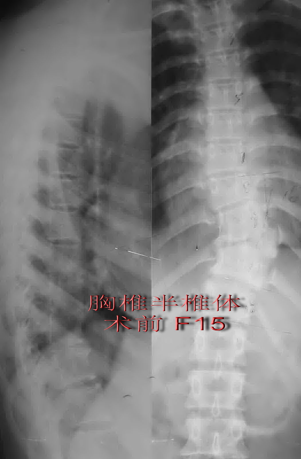 胸椎半椎体图片