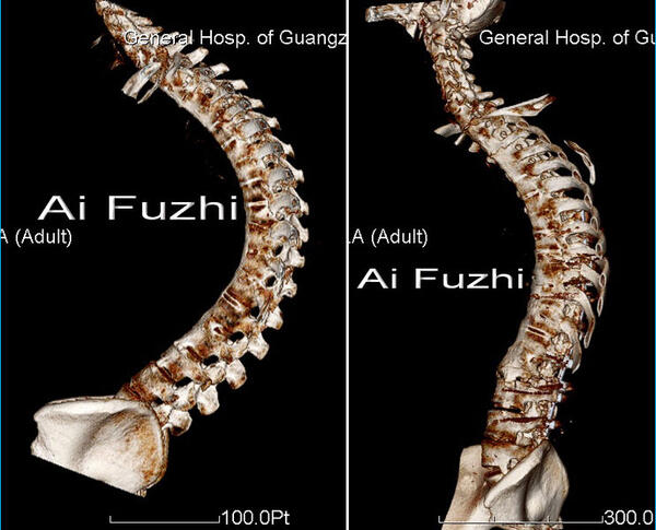 先天性脊柱后凸图片