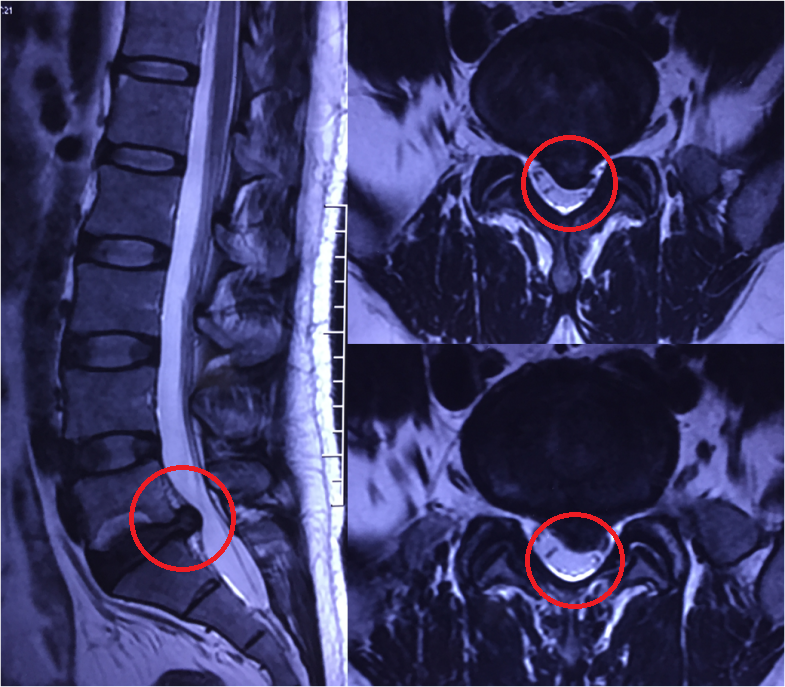 椎间孔镜手术治愈腰5骶1椎间盘突出症患者