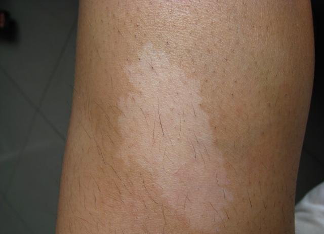 无色素痣 的表现及与白癜风和贫血痣的区别