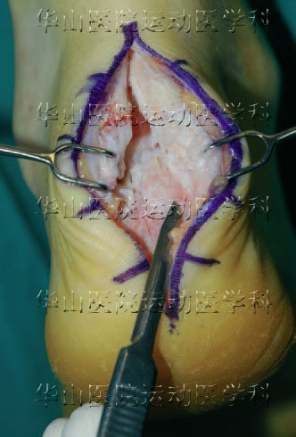 跟腱止点腱病手术中切除变性跟腱