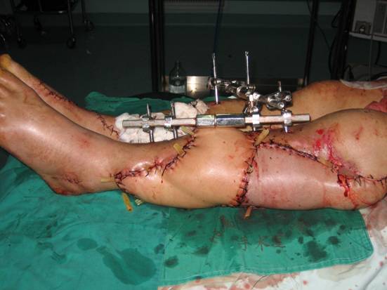 下肢毁损伤的治疗;大段骨缺损的治疗