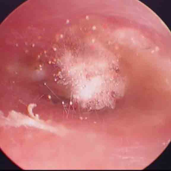 真菌性外耳道炎 附图片 外耳道真菌病 症状 疾病介绍