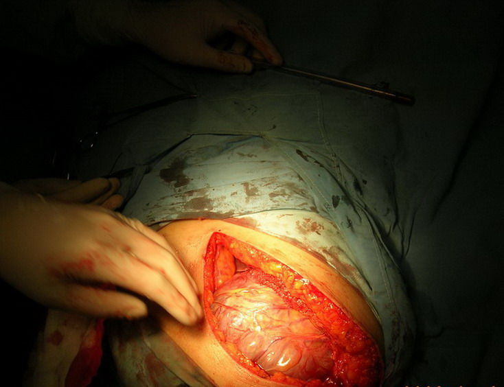 腹腔镜三孔疤痕图片
