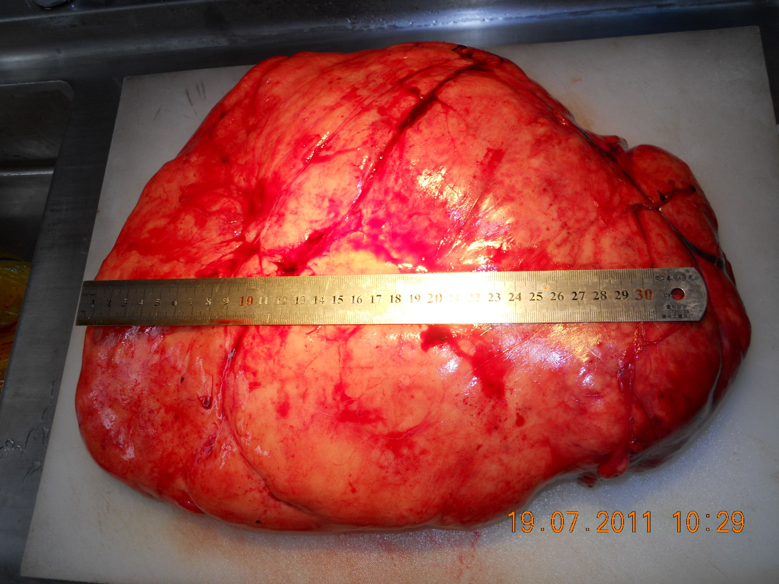 腹膜后肿瘤平滑肌肉瘤图片