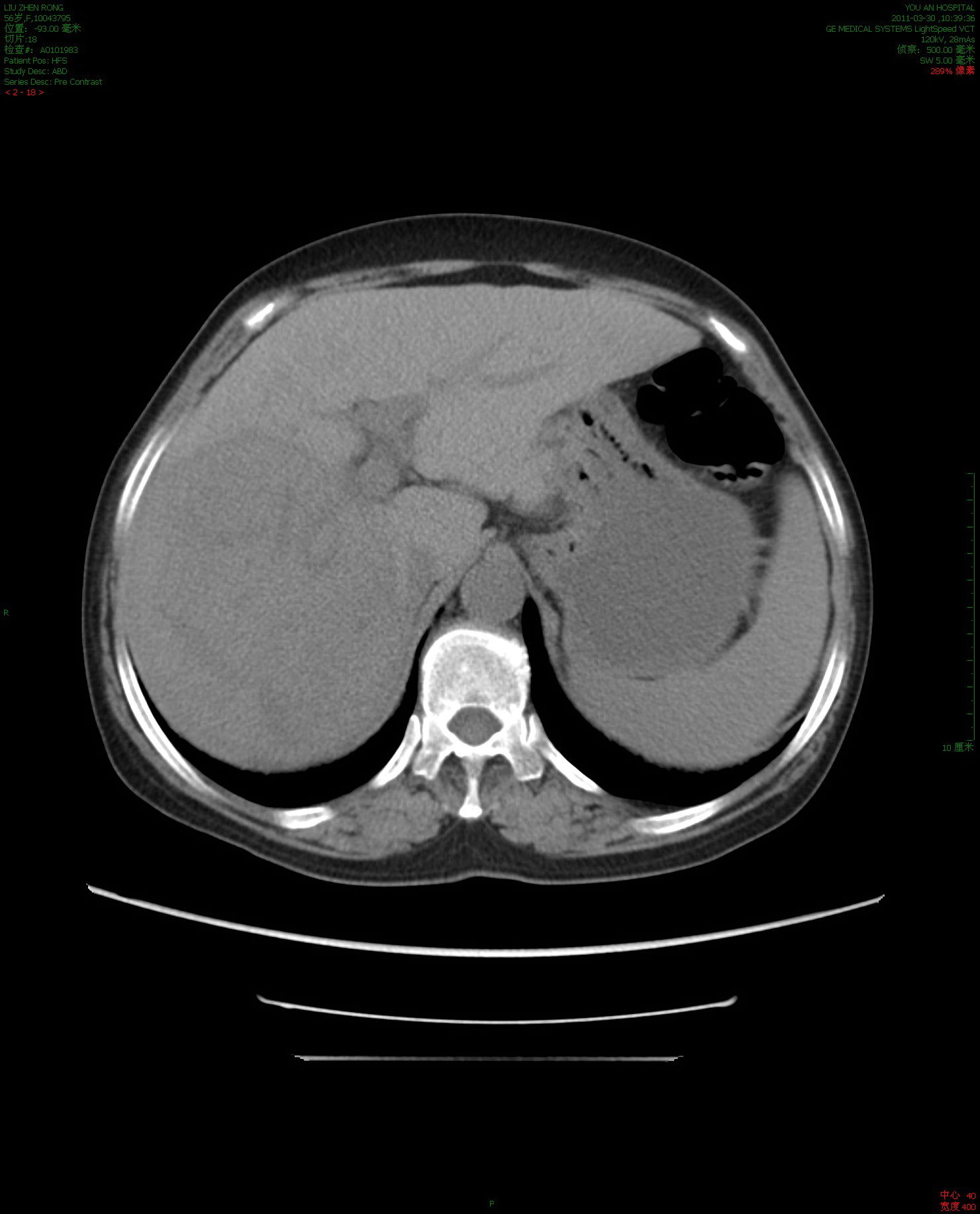 肝癌晚期的微创靶向治疗3(微波消融wma)