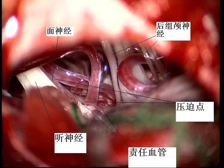 面肌痉挛手术切口图图片