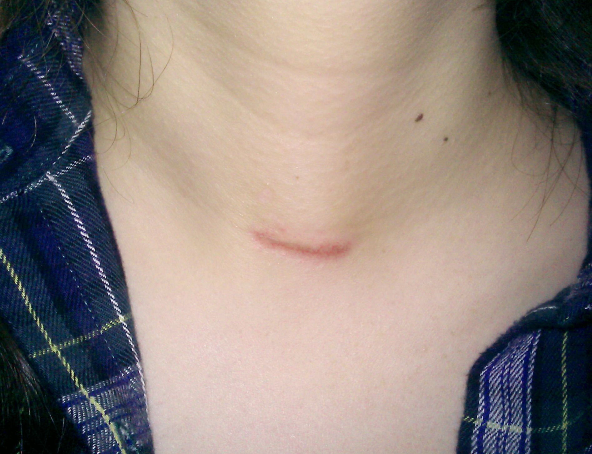 小切口甲状腺手术切口的愈合