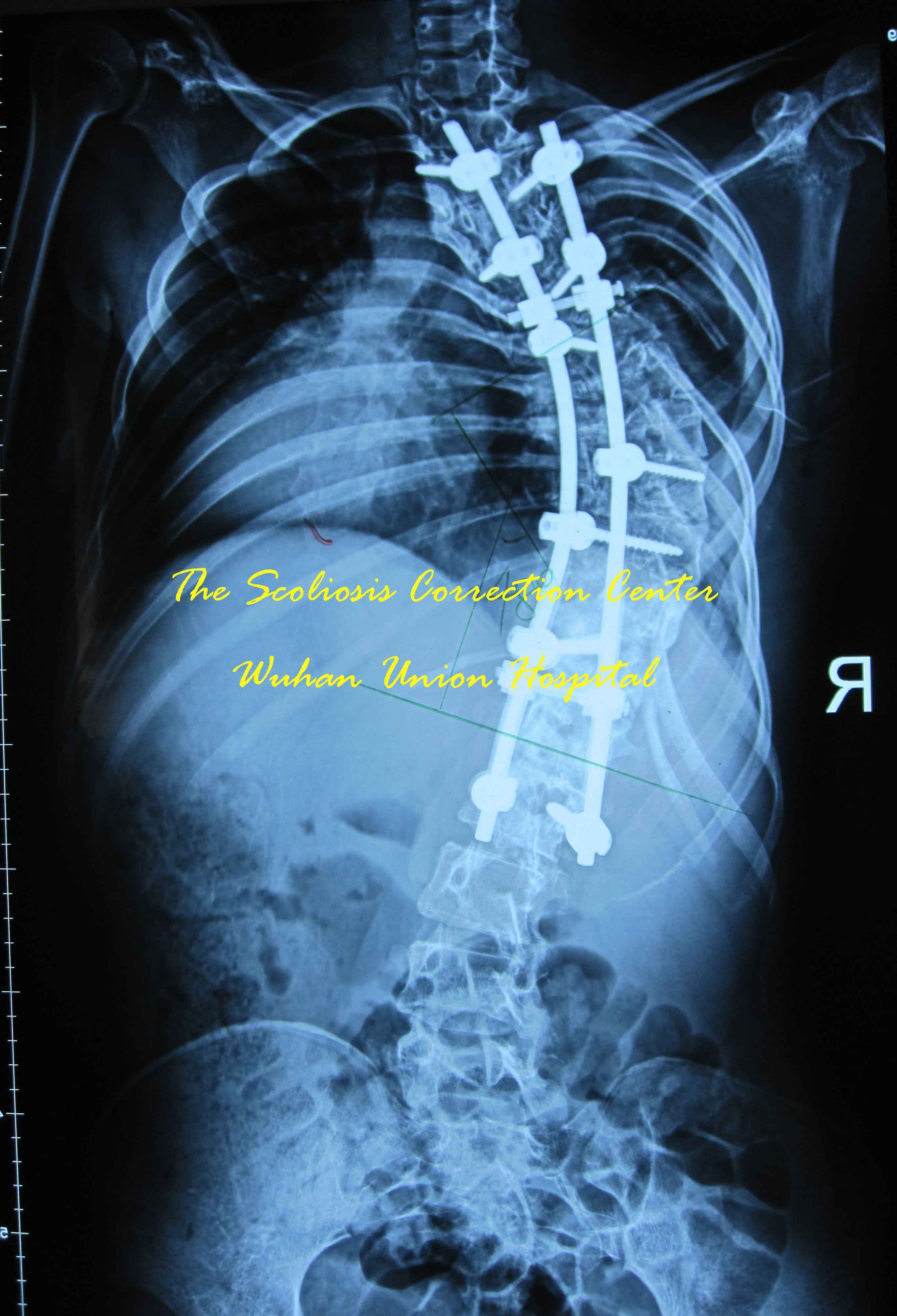 武汉协和医院骨科成功实施极重度脊柱侧凸一期前后路联合矫形