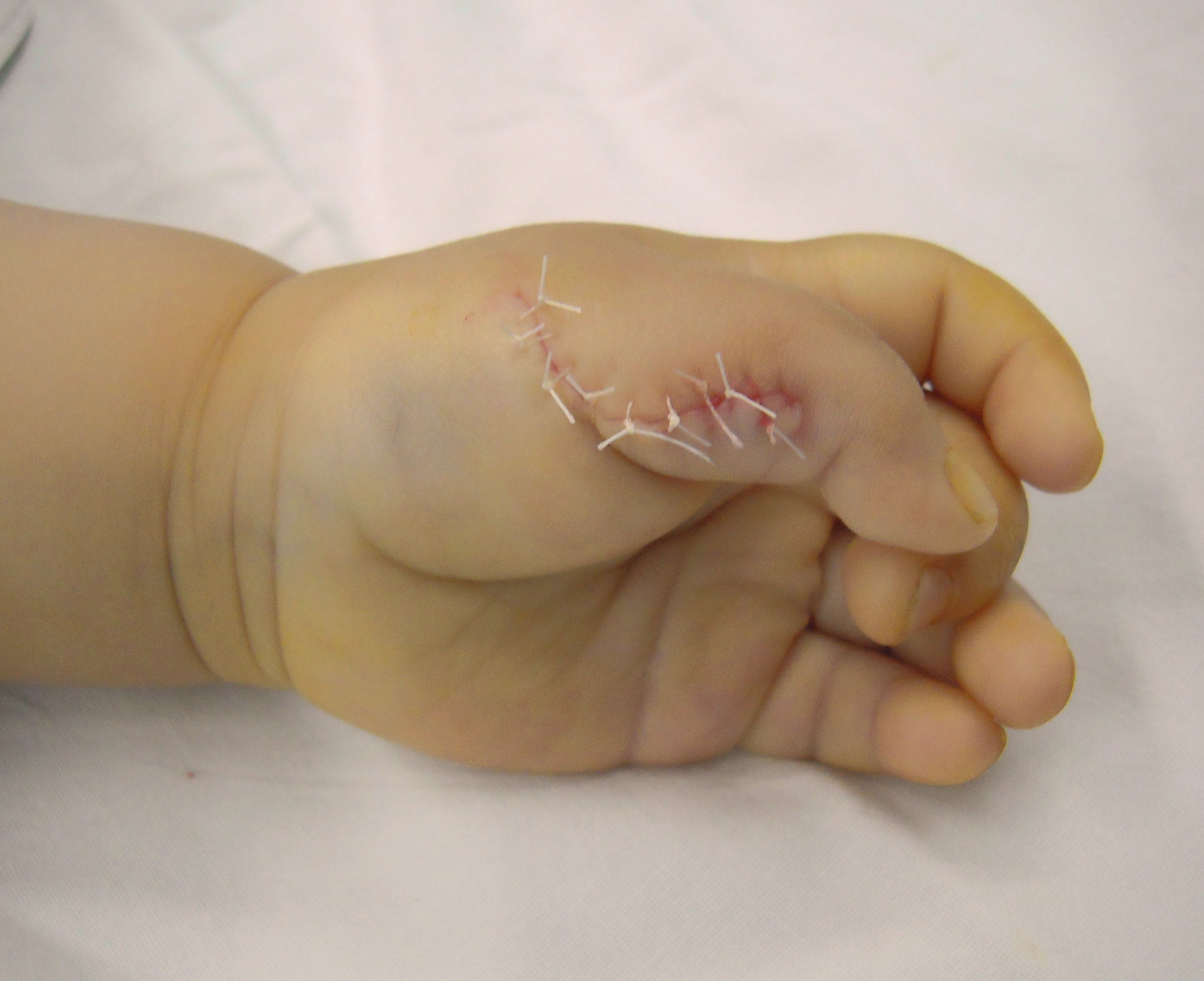 多指畸形概述大量手术实例