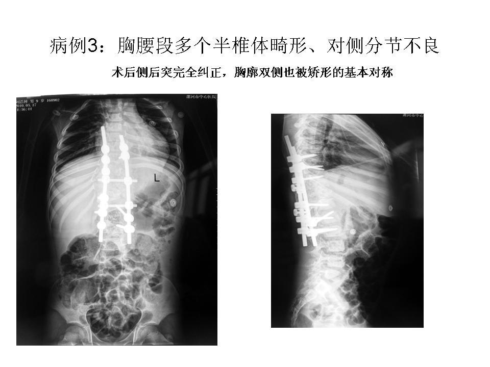 脊柱畸形(羅鍋)矯正手術病例3