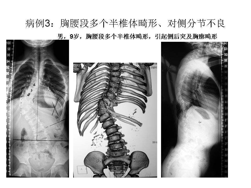 脊柱畸形(羅鍋)矯正手術病例3