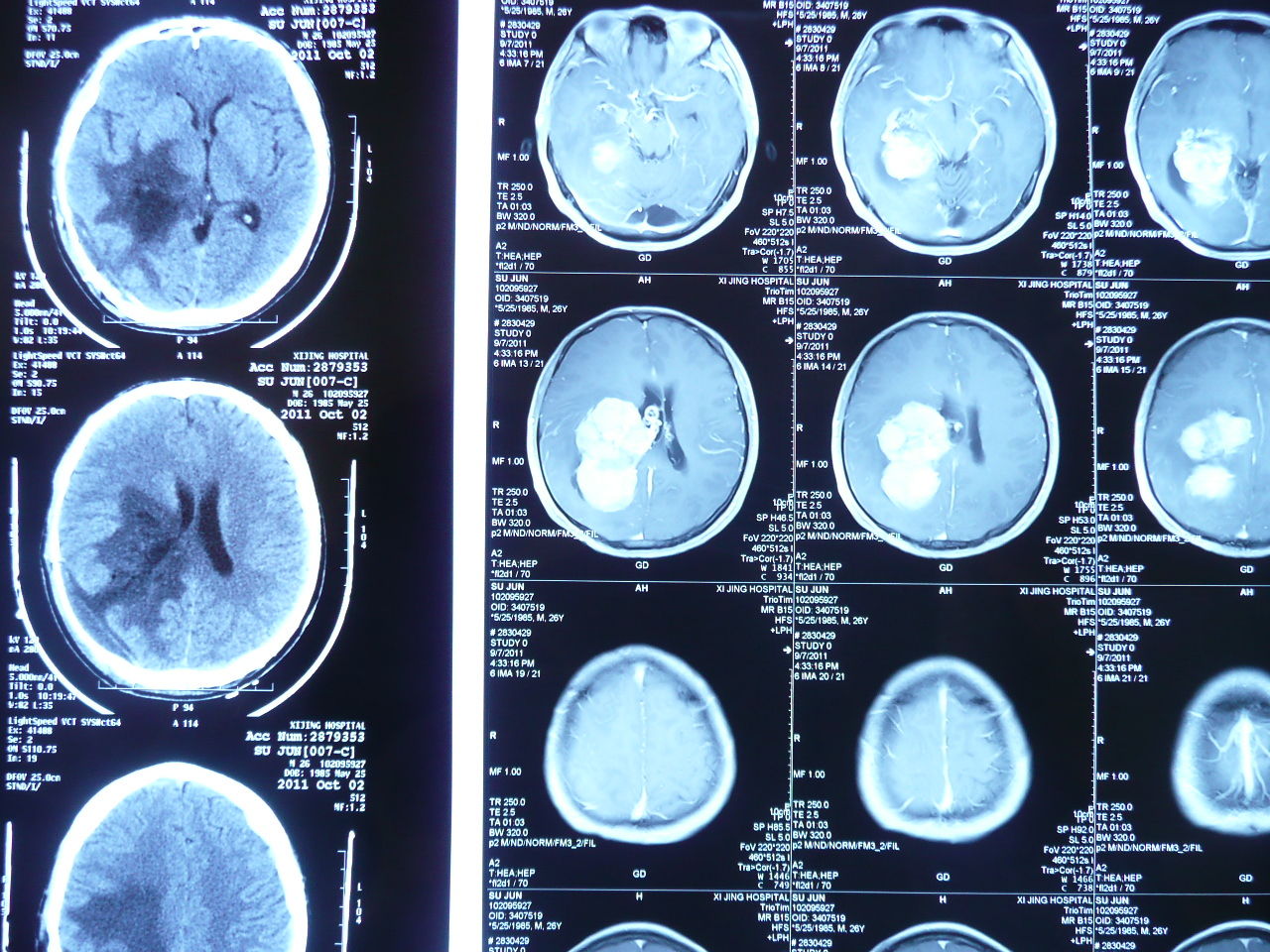 头痛 , 头晕 .ct,mri显示:右侧脑室内巨大 肿瘤 .