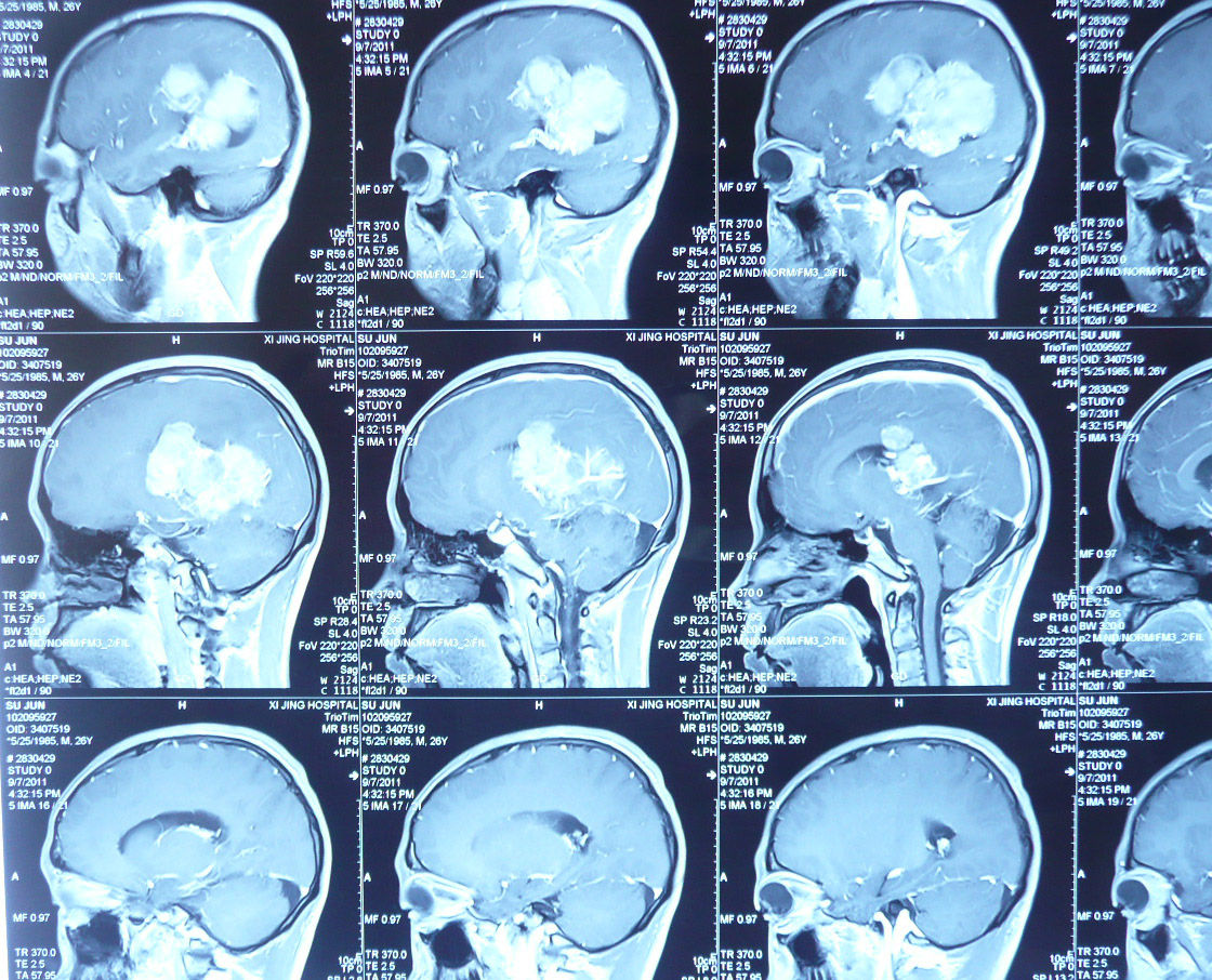 罕见巨大颅内肿瘤手术治疗实例