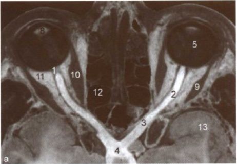 视神经管ct扫描范围图片