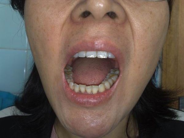 张口受限不可复性盘前移位怎么办