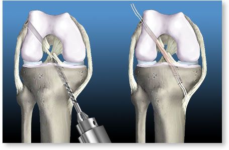 好大夫在线 朱述浪 > 前交叉韧带损伤下图是前交叉韧带断裂后重建的