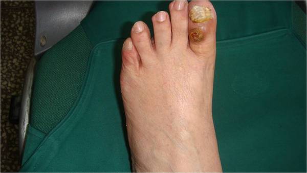 脚趾粘液囊肿的治疗 - 好大夫在线